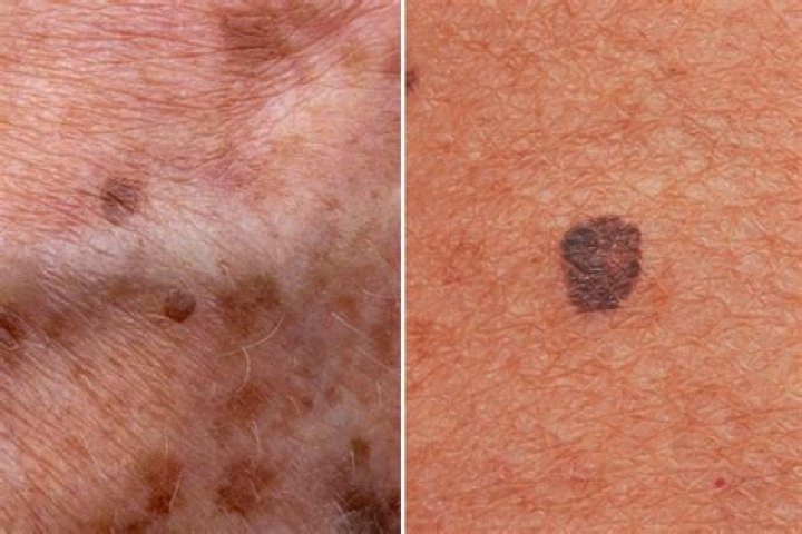 Can melanoma cause hot flashes?