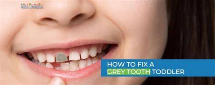 Can you fix a grey tooth?