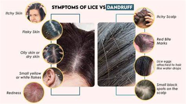 Do lice look like dandruff?