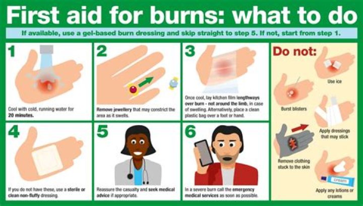 How do you stop a burn from throbbing?
