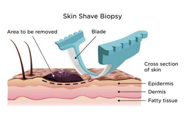 How long does a biopsy for melanoma take?