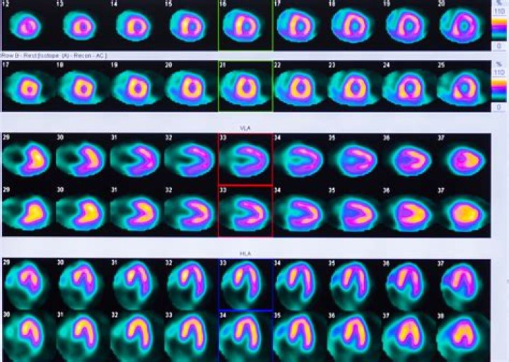 Is a heart scan better than a stress test?