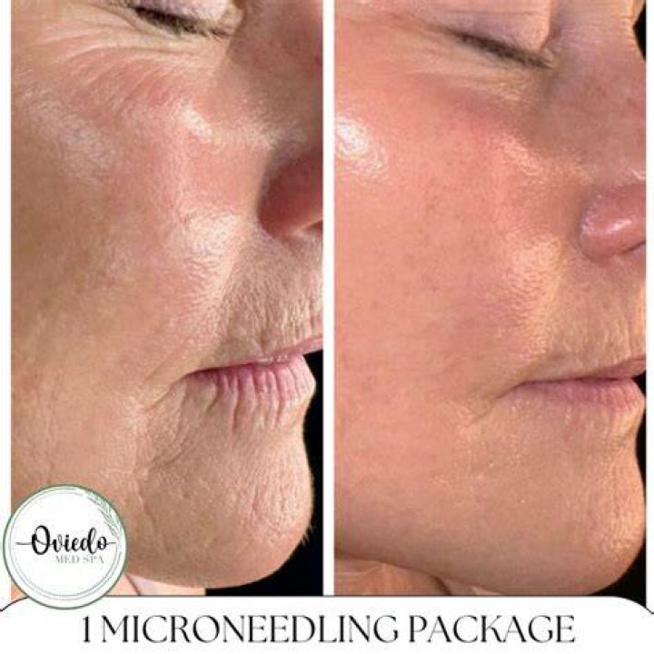 Is one session of microneedling enough?