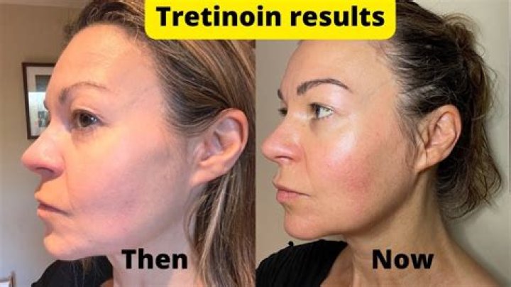 Should I use retinol on my neck?
