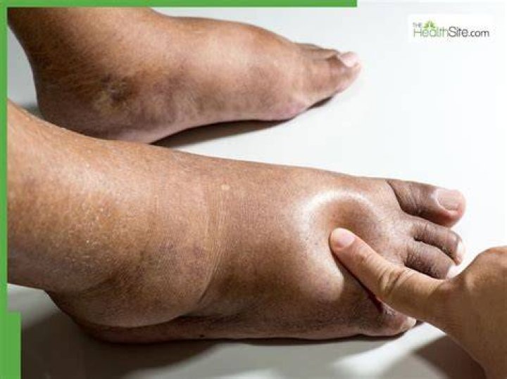 What causes feet to swell and turn black?